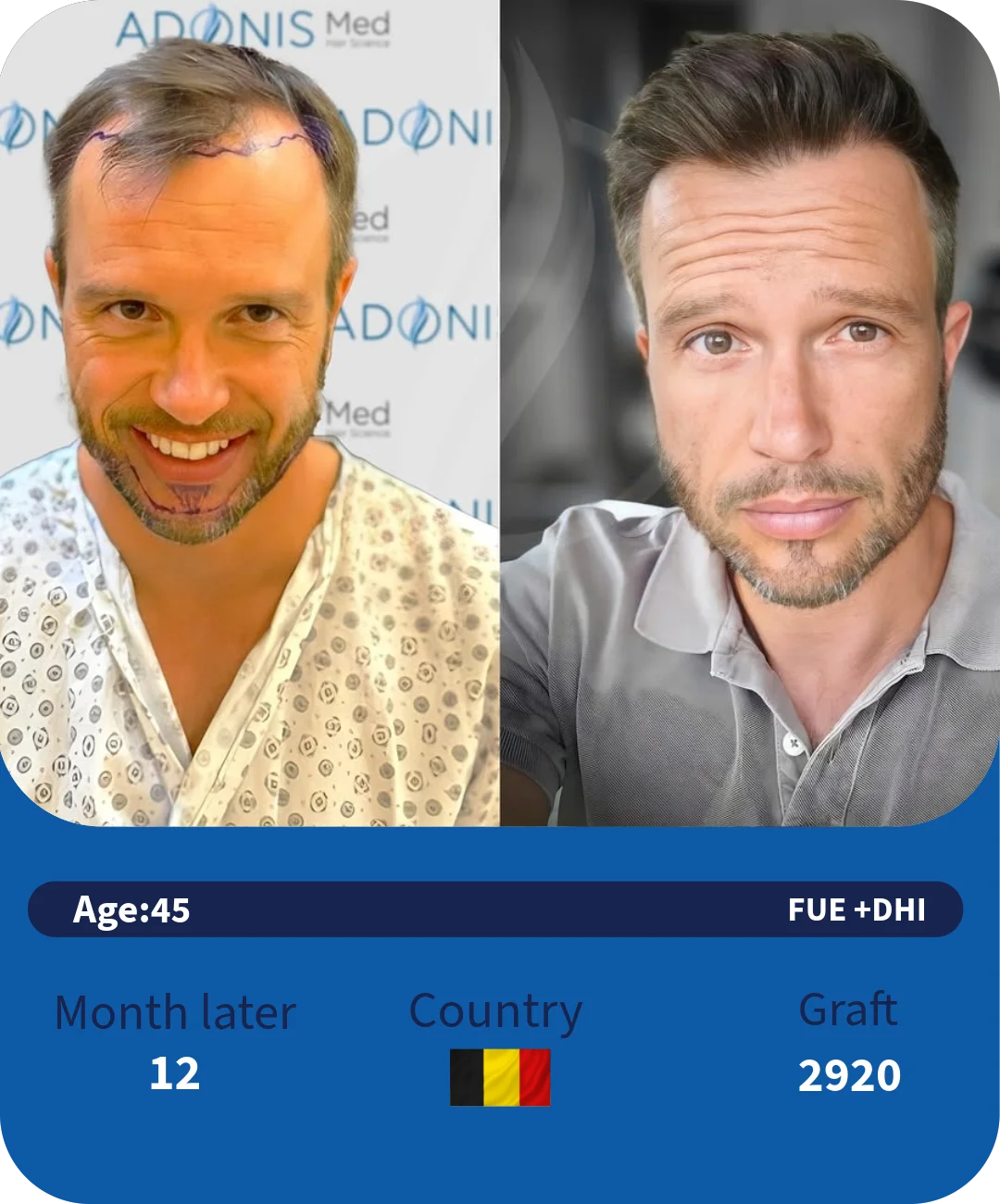 Combined Hair and Beard Transplant: A Guide to Maximum Transformation in One Session