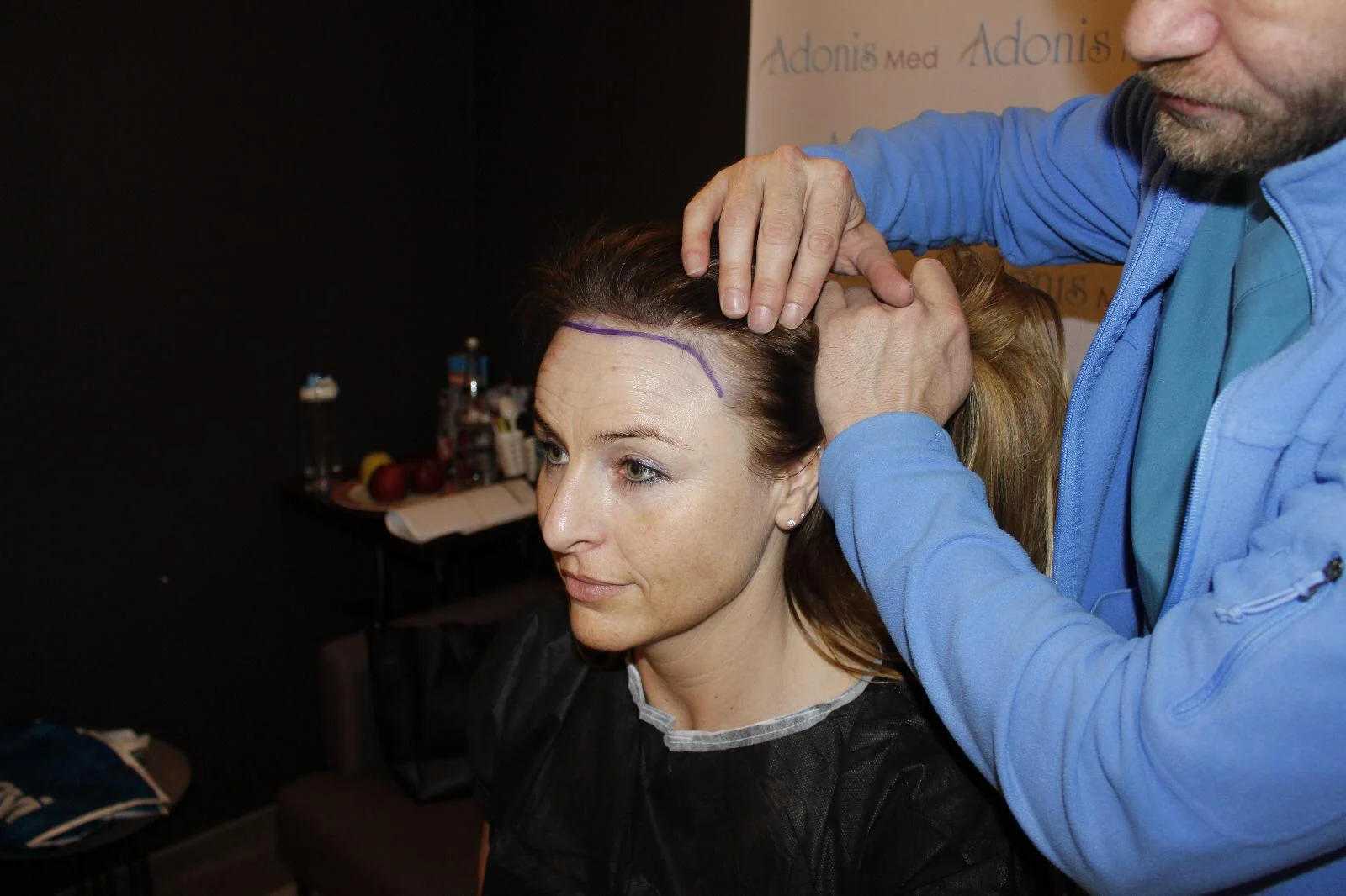 High hairline hair transplant