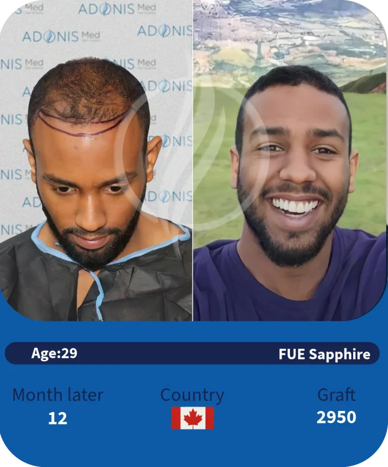 before-after-adonismed-hairtransplant (3)