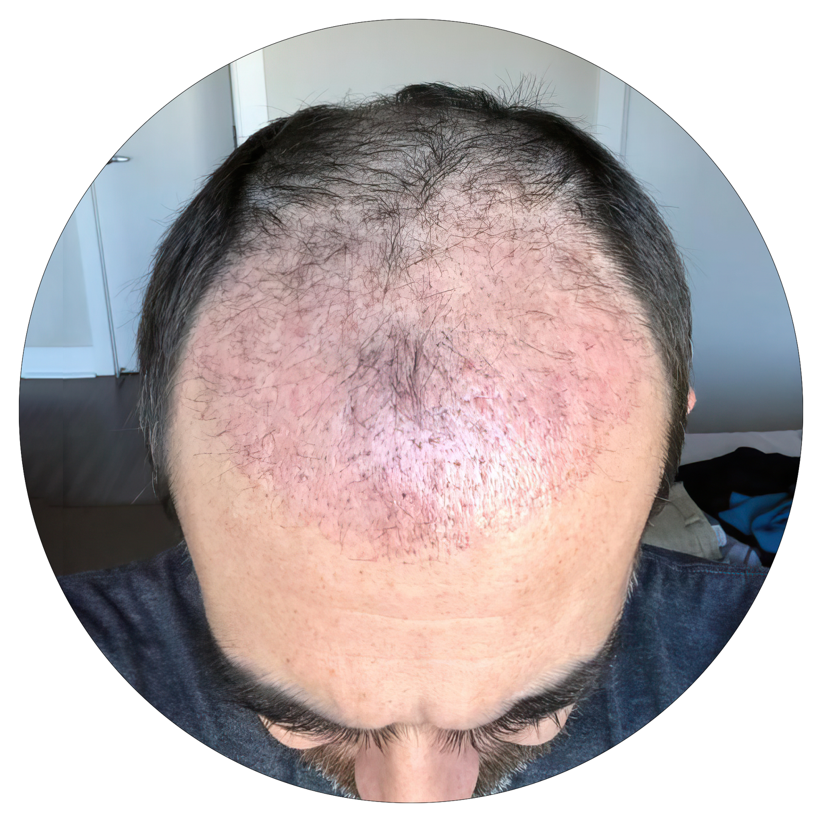 What is Shock Loss? Why Do Transplanted Hairs Fall Out?