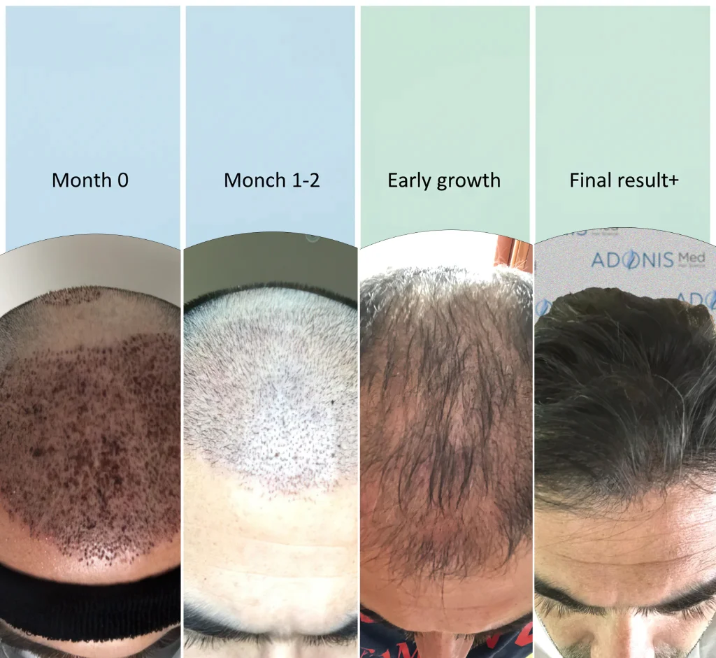 Hair Transplantation Recovery Process (Month by Month): Shock Loss and the Emergence of New Hair