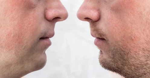 beard-transplant-shaving