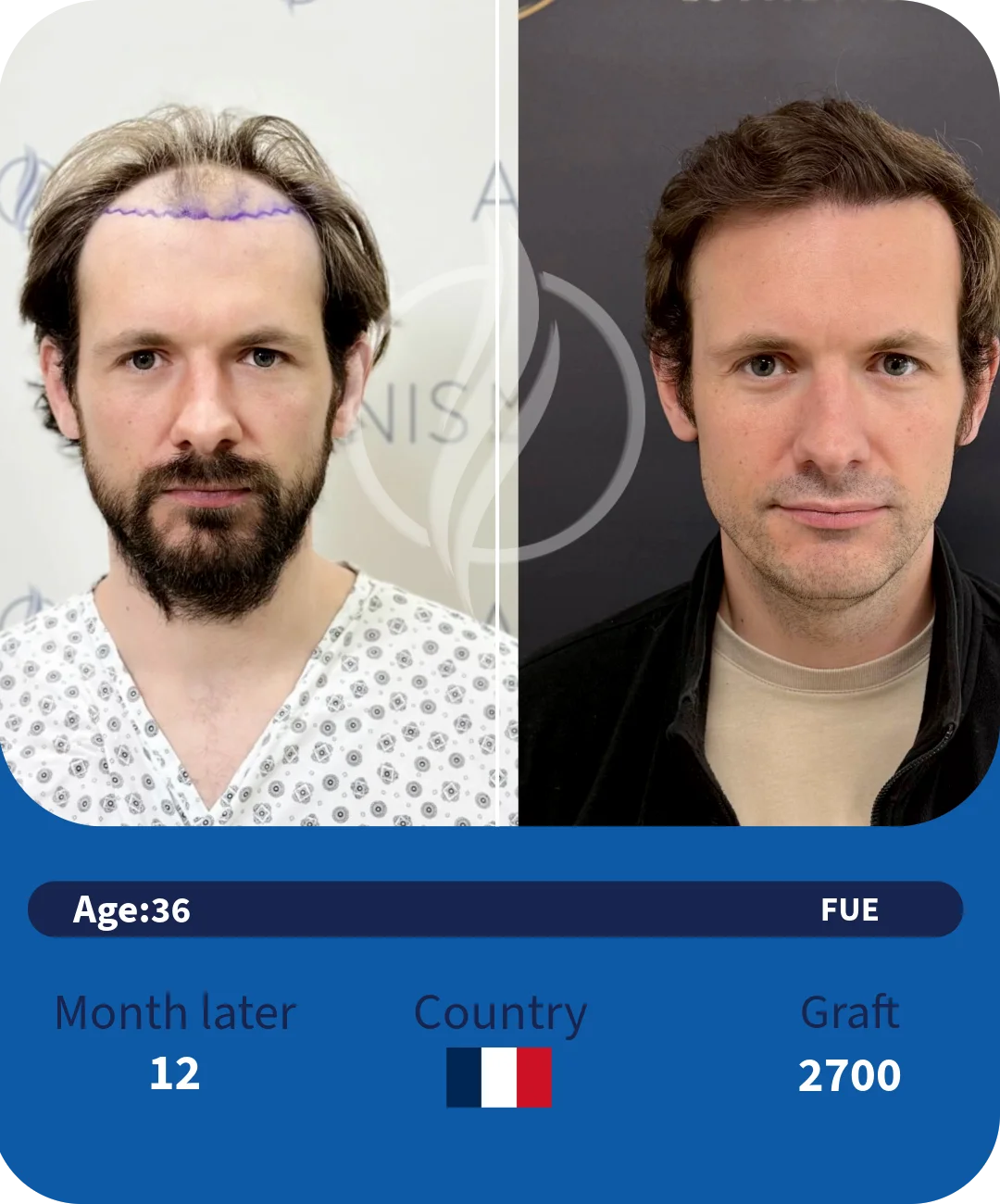 Confidence Transformation After Hair Transplant: A Story of Psychological Renewal