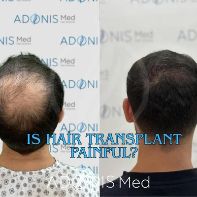 Is Hair Transplant Painful? Everything You Need to Know About the Process