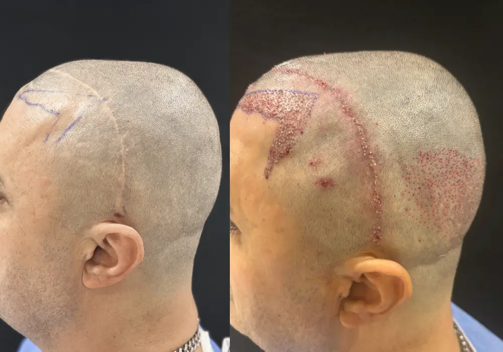 Can Hair Be Transplanted Over a Scar?